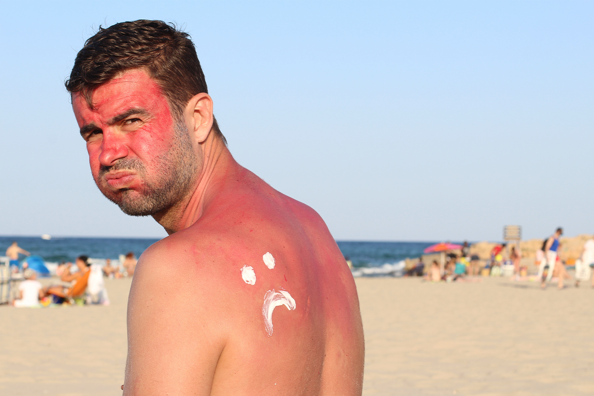 How Long Does Sunburn Last? FUNBOY