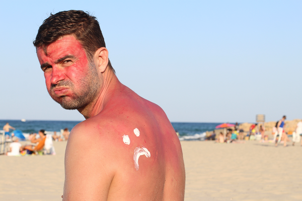 sunburn_600x.png